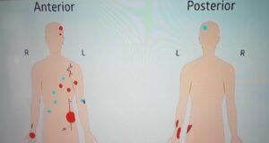 Shrapnel Close To Heart, Multiple Surgeries Later, Nasheed Recovering